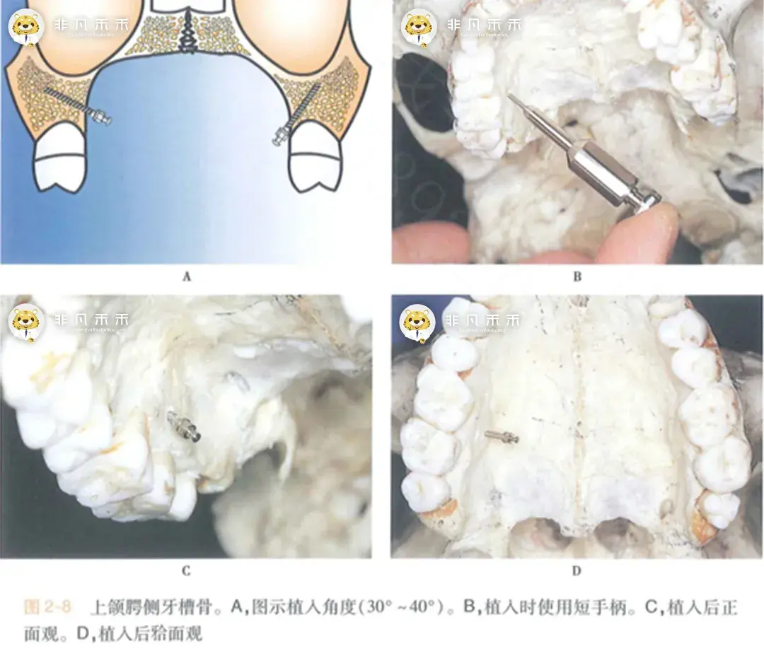 上前牙外伤种植术后感染致重度骨缺损上部结构修复聚醚醚酮(PEEK)支架+树脂堆塑技术-口腔科学-医学