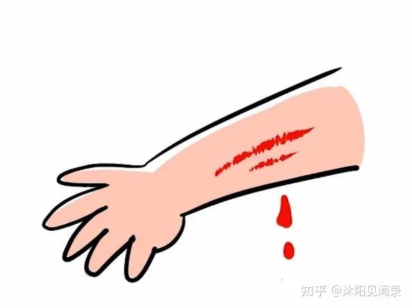 创伤出血的类别与症状 - 知乎