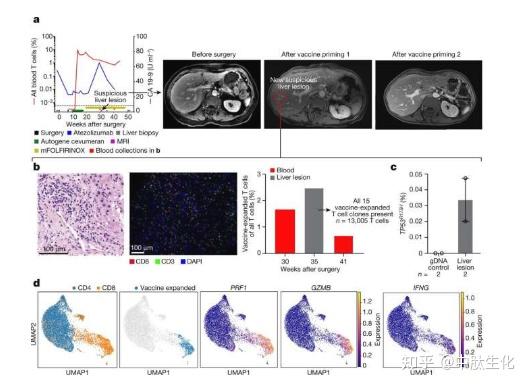 Nature：个性化的mrna疫苗在临床试验中或有望治疗人类胰腺导管腺癌 知乎