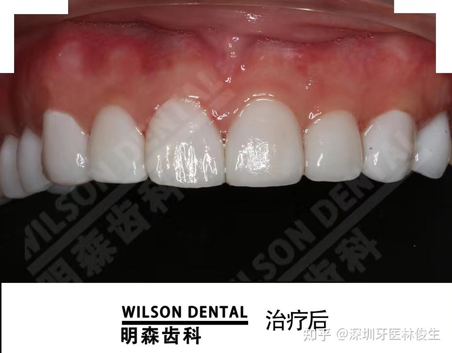 智齿拔除+连冠修复+树脂补牙+上颌窦提升内、外提+骨粉、骨膜植入+牙齿种植+贴面美白,复杂综合案例 - 知乎