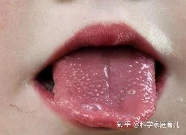 会逐渐变干净，从而舌头显现鲜红、舌乳头凸起，俗称“杨梅舌”。草莓舌