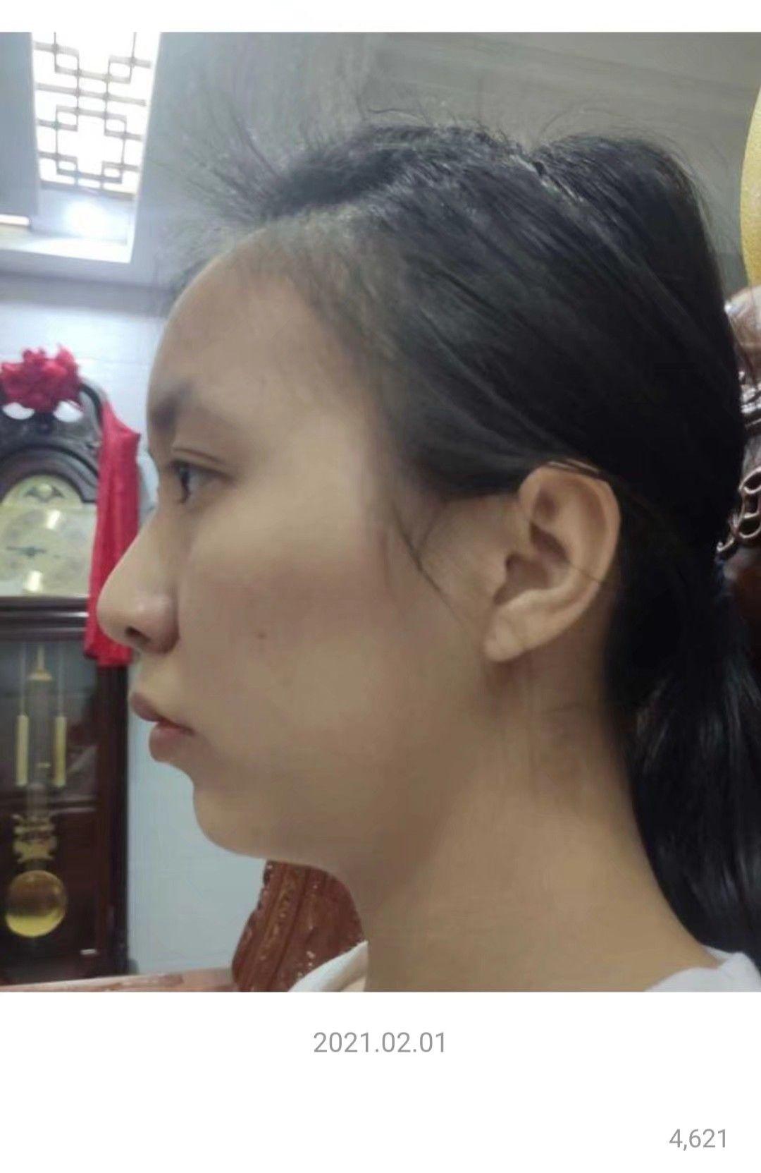 牙齿矫正后侧面变化有多大? - 知乎