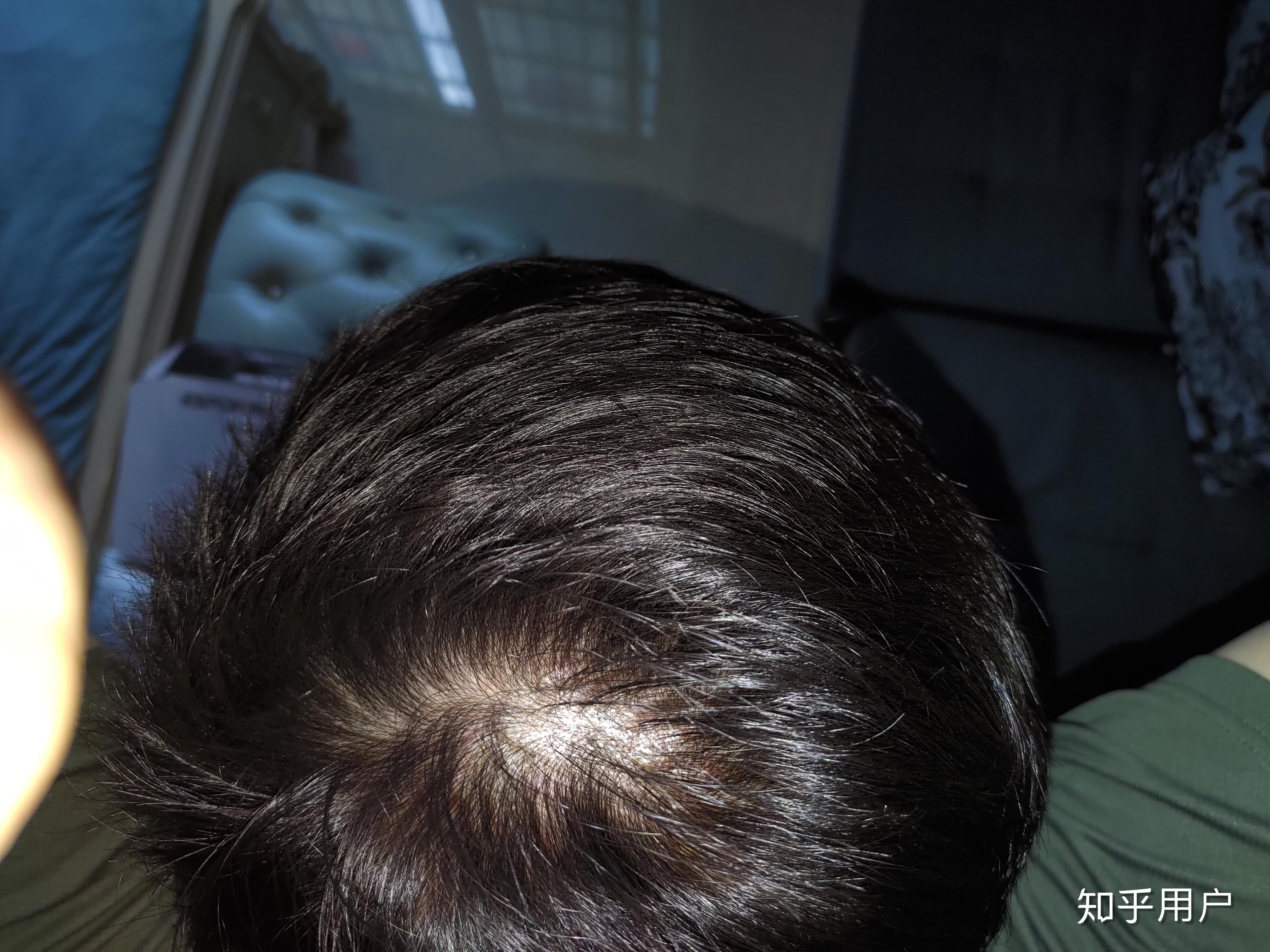发旋附近头发少(有图),像这样正常吗? - 知乎