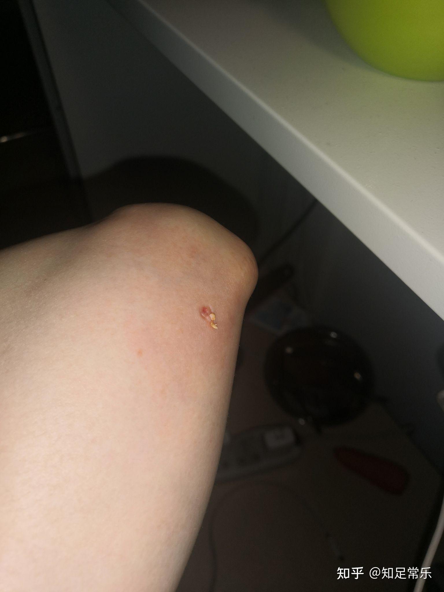 手臂右侧肘关节内出皮下长了硬疙瘩