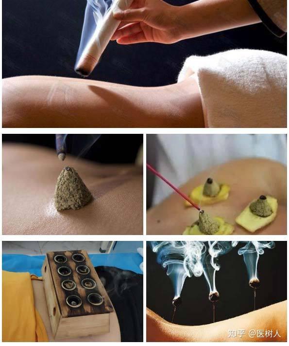 用艾灸激活免疫力防疫治病