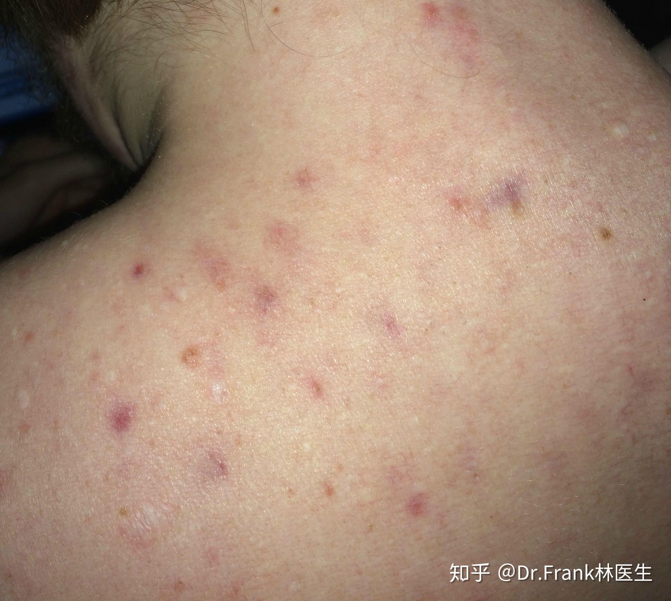 你一直误认自己是所谓的"疤痕体质"而拒绝治疗么?