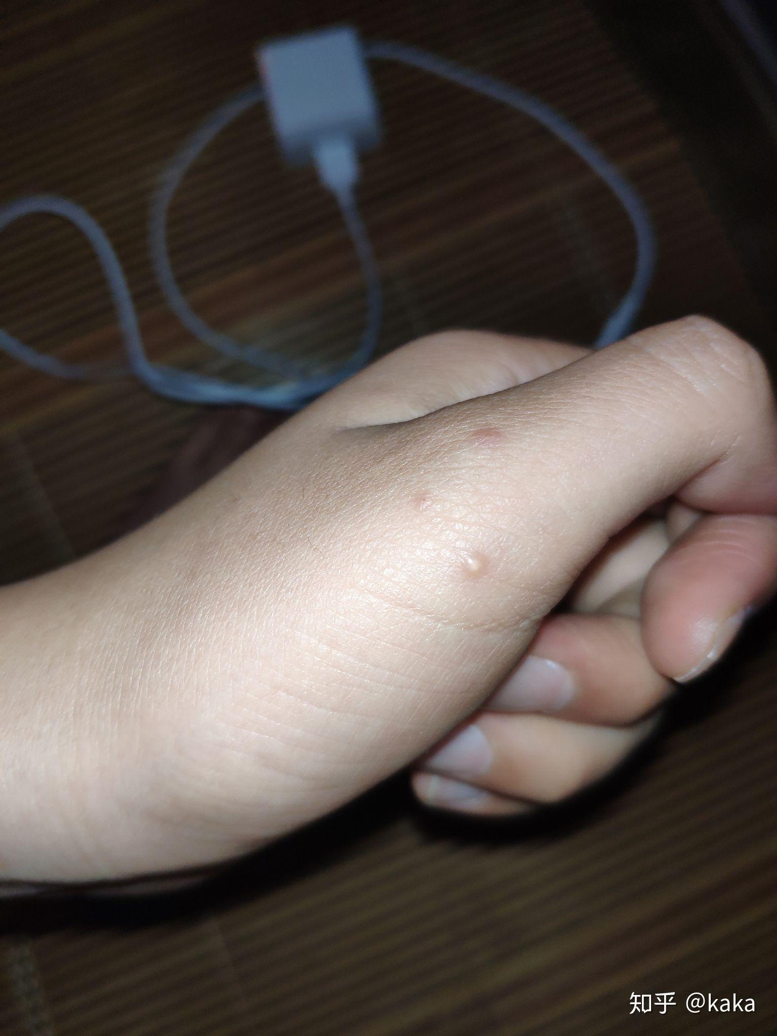 手部皮肤上长了透明小包(小疙瘩),不痛不痒,微硬,请问这是什么?