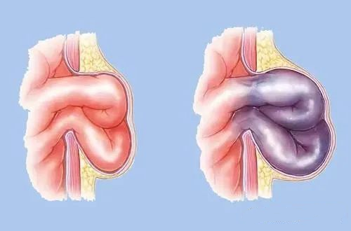 小儿腹壁疝气图片