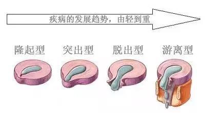 病例 颈椎间盘突出该怎么治疗 知乎