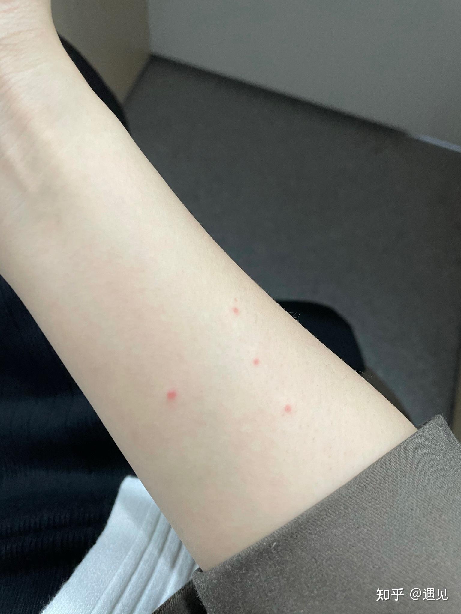 最近身上又长了几个红点像血点以前只有一个而且消不下去