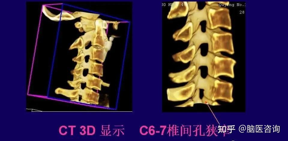 頸椎病拍片子的那些事兒