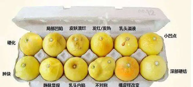 乳腺结核可并有皮肤溃疡或瘘管,乳腺癌可出现皮肤内陷形成"酒窝症"