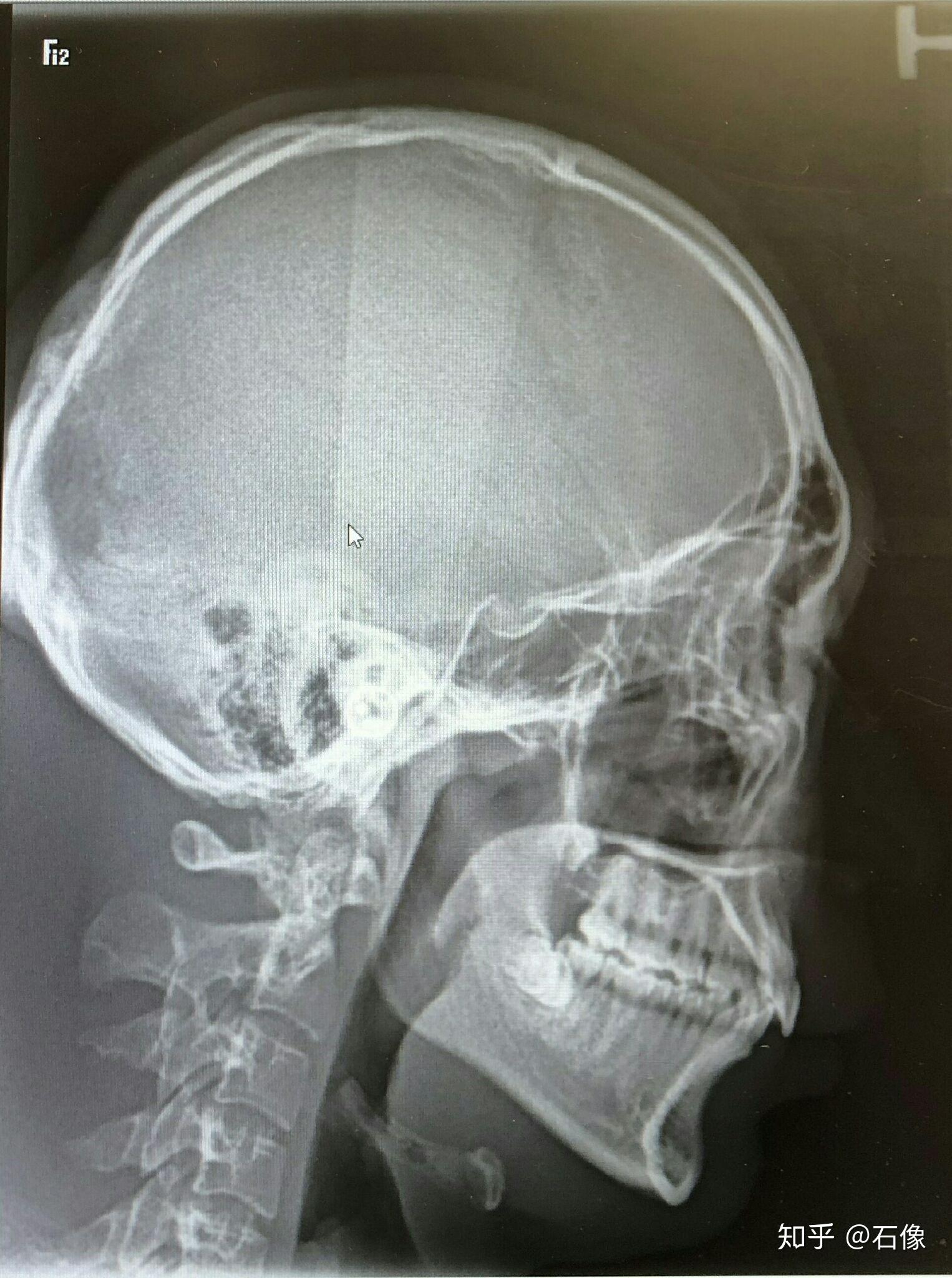 深覆合矫正方法?