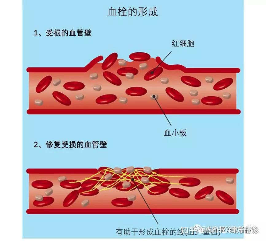 癌症相关血栓的发病风险、危害和诊断 - 知乎