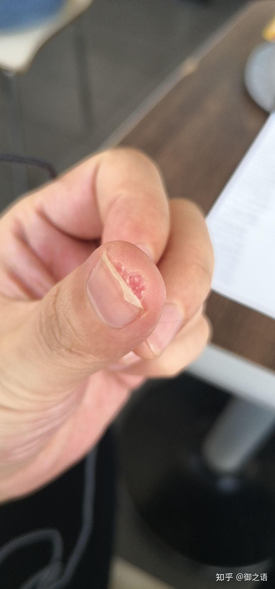 按照将军方法治疗甲周疣