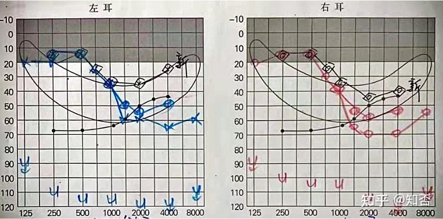 重庆渝北加州惠耳案例分享助听器声治疗对耳鸣的干预