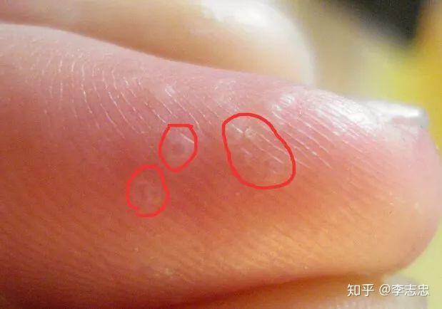 中医辨证解析汗疱疹! - 知乎