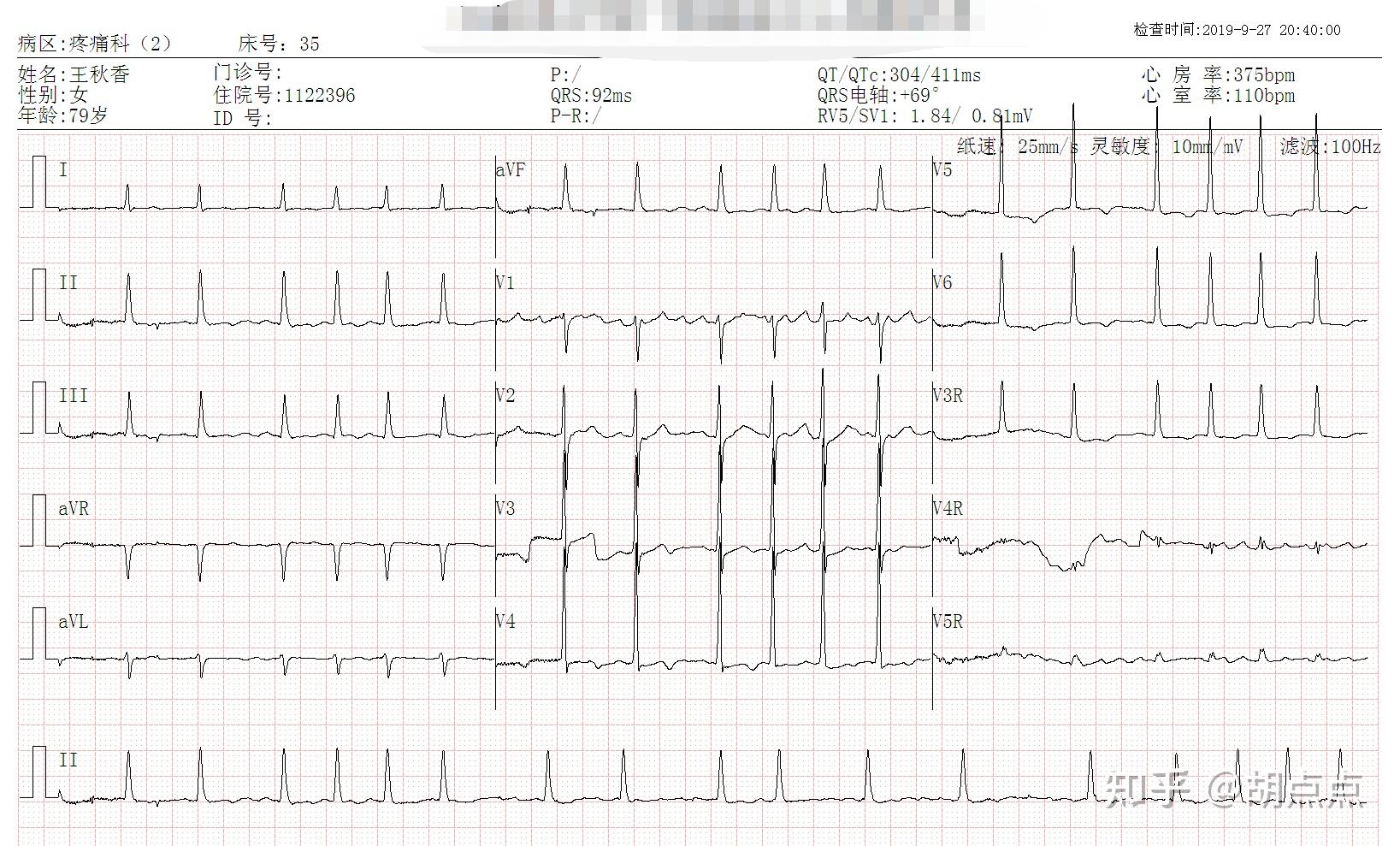 做心电图如下所示,请选择可能的心电图诊断a,室性期前收缩二联律b