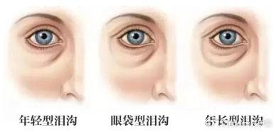 泪沟成因大揭秘:为什么有些人年纪轻轻就有? - 知乎