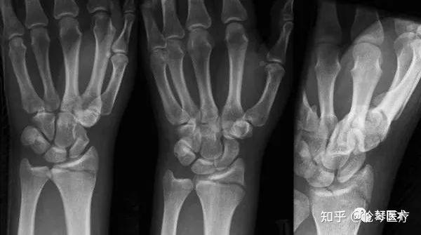 雪台风天易摔伤建议影像医生提前收藏这99张骨折影像伦琴医疗