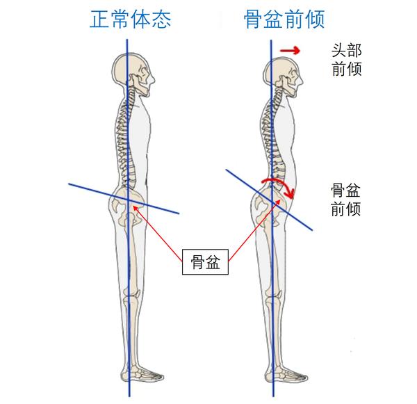 髂腰肌过度锻炼会引起骨盆前倾? - 知乎