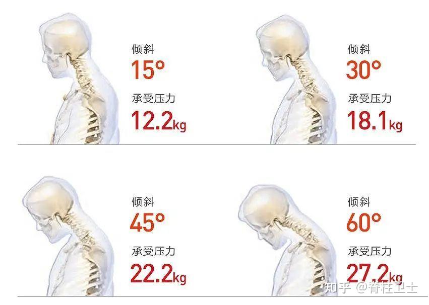 如何区分富贵包和颈椎病？ - 知乎