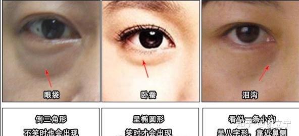 有没有大佬帮我看一看是卧蚕还是眼袋