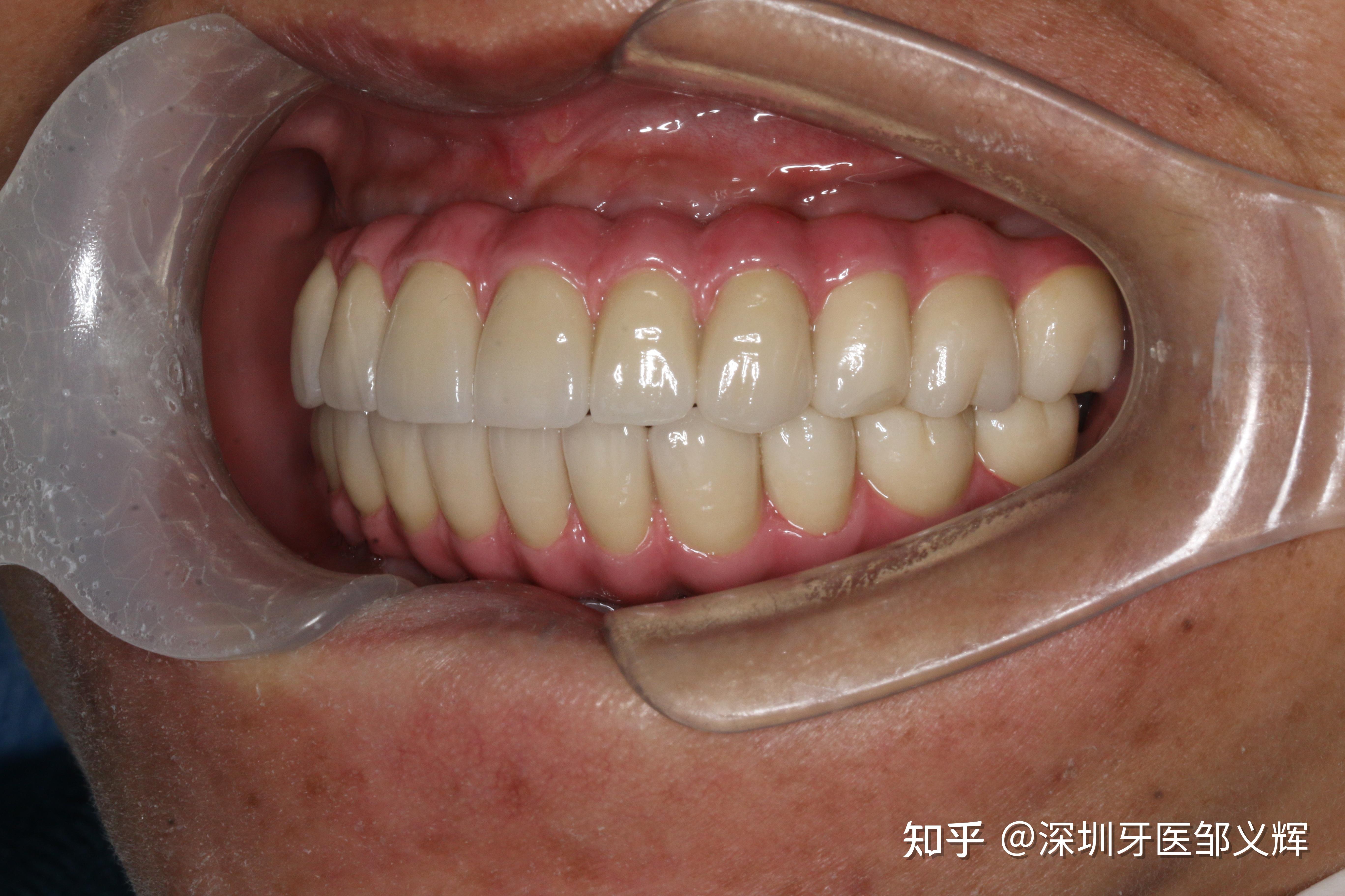 无牙颌修复一例