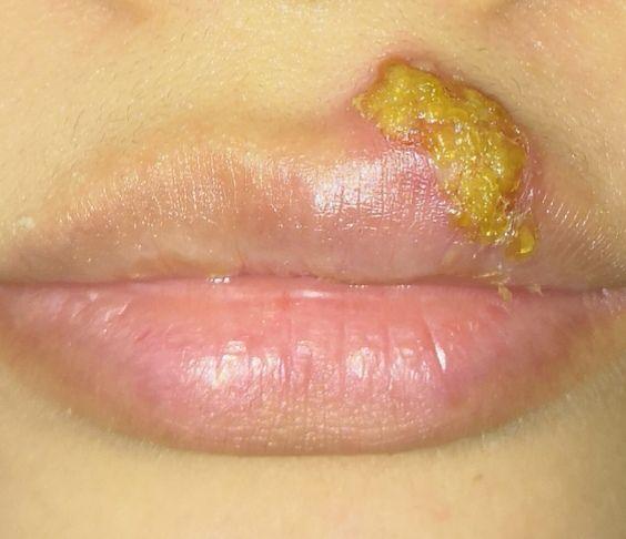 女朋友嘴角涨了疱疹有10年了老是复发有没有啥办法