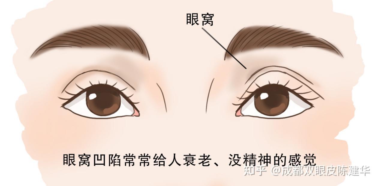 形成眼部凹陷的一种原因是眶隔膜太紧,以至于脂肪不能表现出来,那么