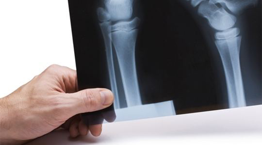 不容忽视的肾性骨病肾脏不好竟然会导致骨骼出现问题