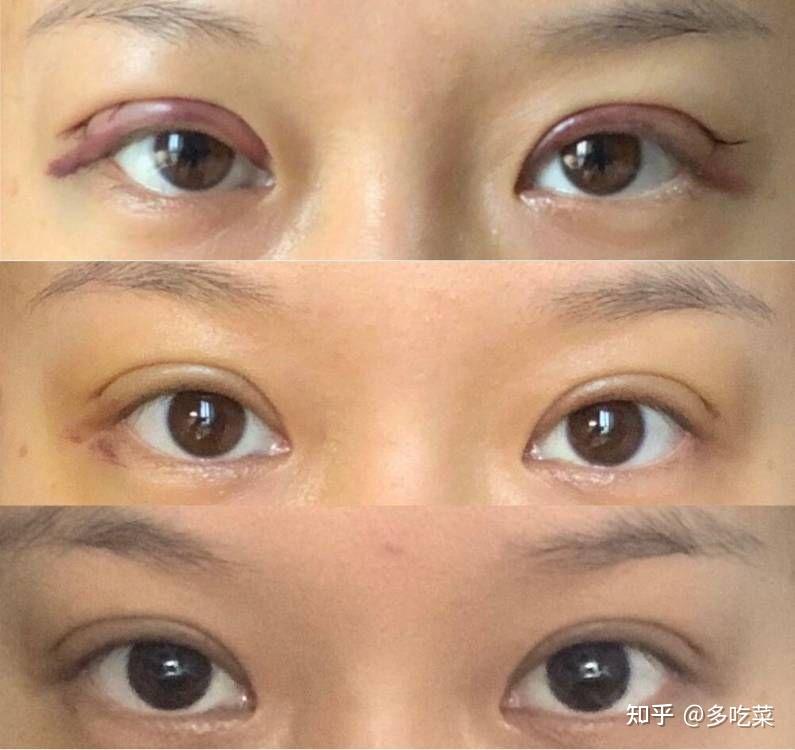 南昌的哪个医生双眼皮做的比较好? - 知乎