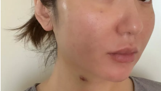 做完微针后多久可以化妆一周两周微针后前三天护理我是这样做的