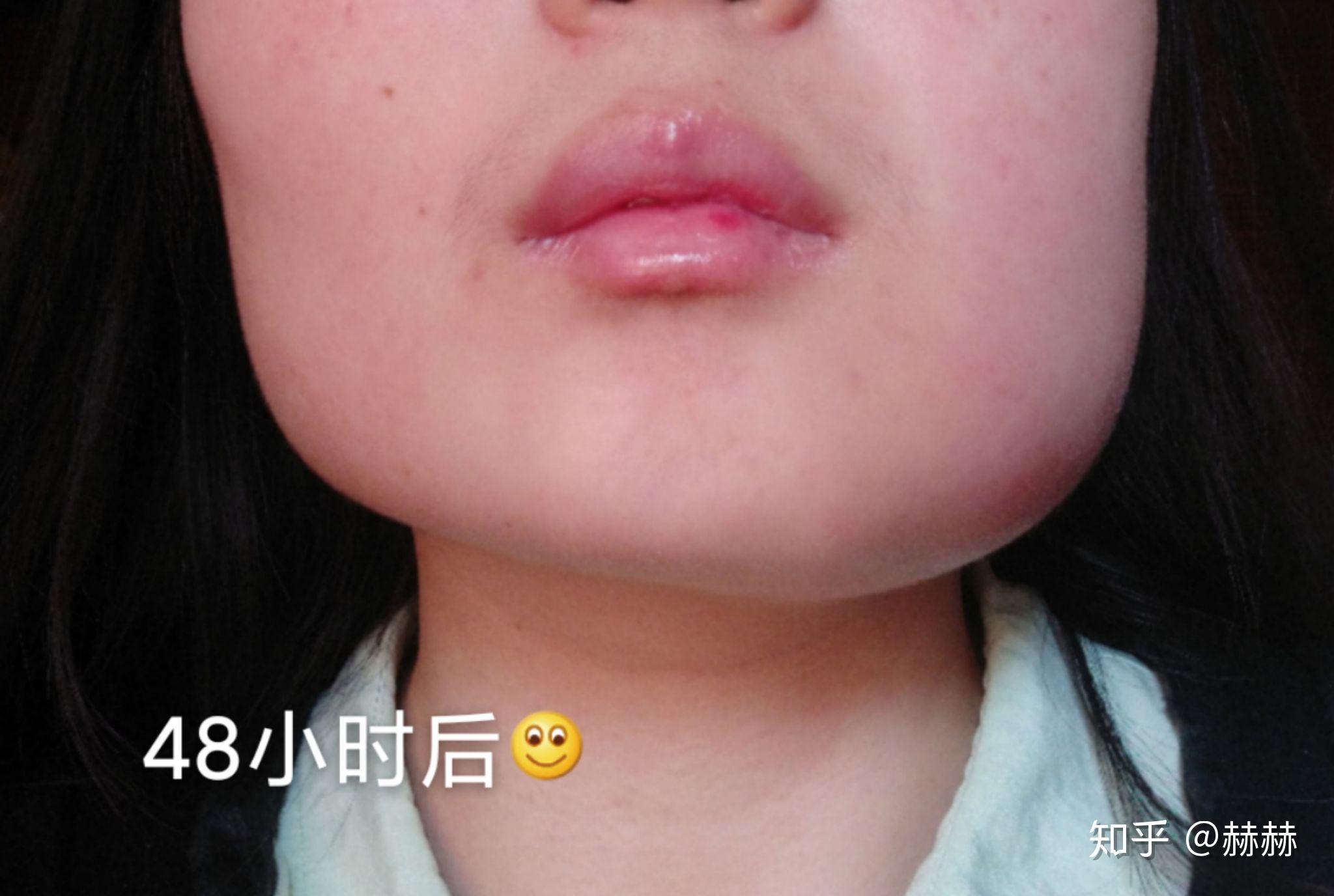 拔水平阻生智齿,术后第二天脸肿了,请问几天能消肿? - 知乎
