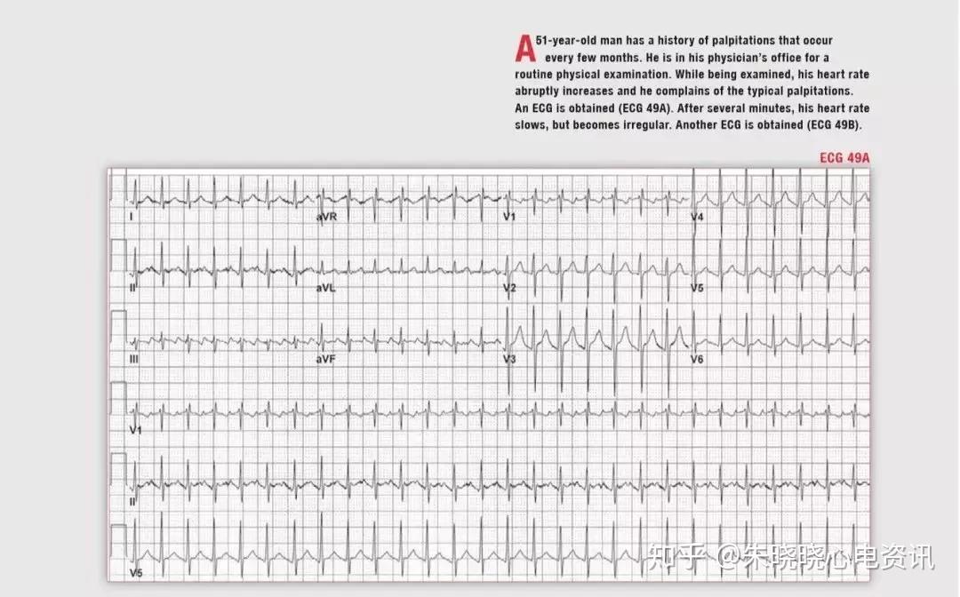 房速和房扑不好区分?记住这一点就行了