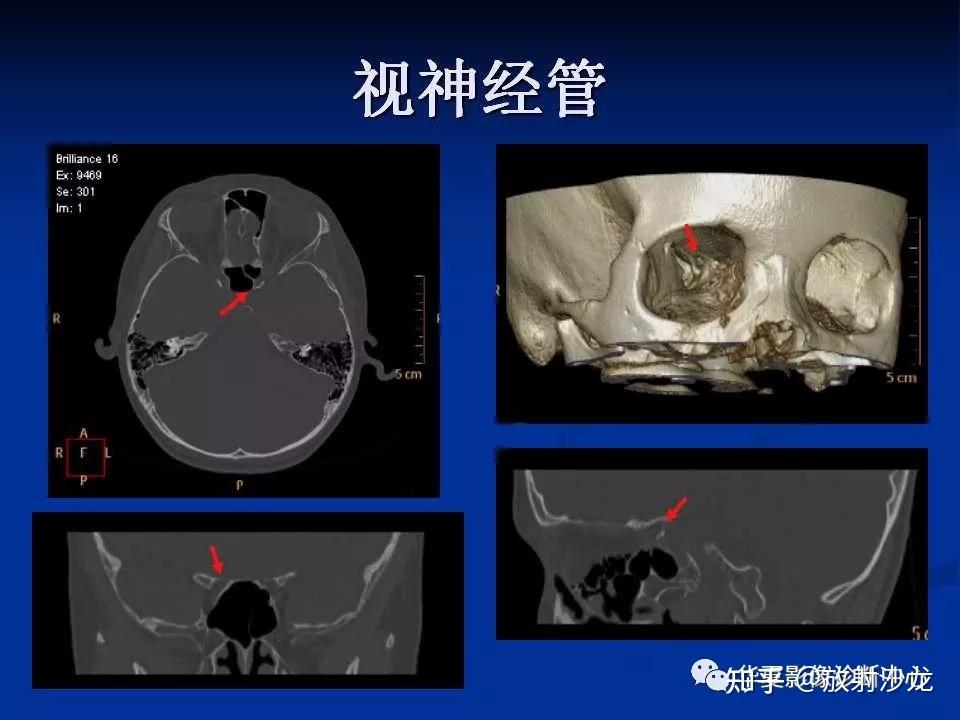 無骨性偽影,多方位成像等特點在顯示正常顱底神經,血管等結構及其病變