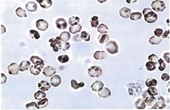 非均一性红细胞3,白细胞和脓细胞:尿液中的白细胞和脓细胞增多常见于