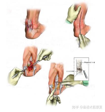 跟腱缝合方法图示图片