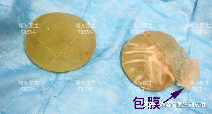 假体隆胸的假体能放一辈子吗