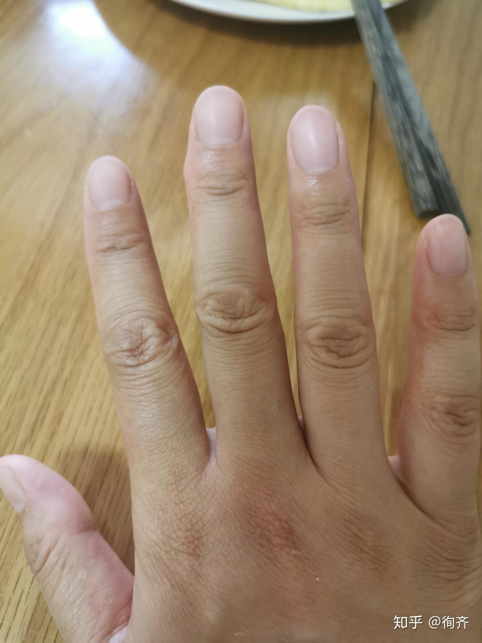 长期错误握笔导致中指有肿块要如何去除? - 知乎