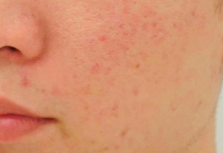 红色痘印怎么去除 别跟普通红痘痘混淆用错方法改善 知乎