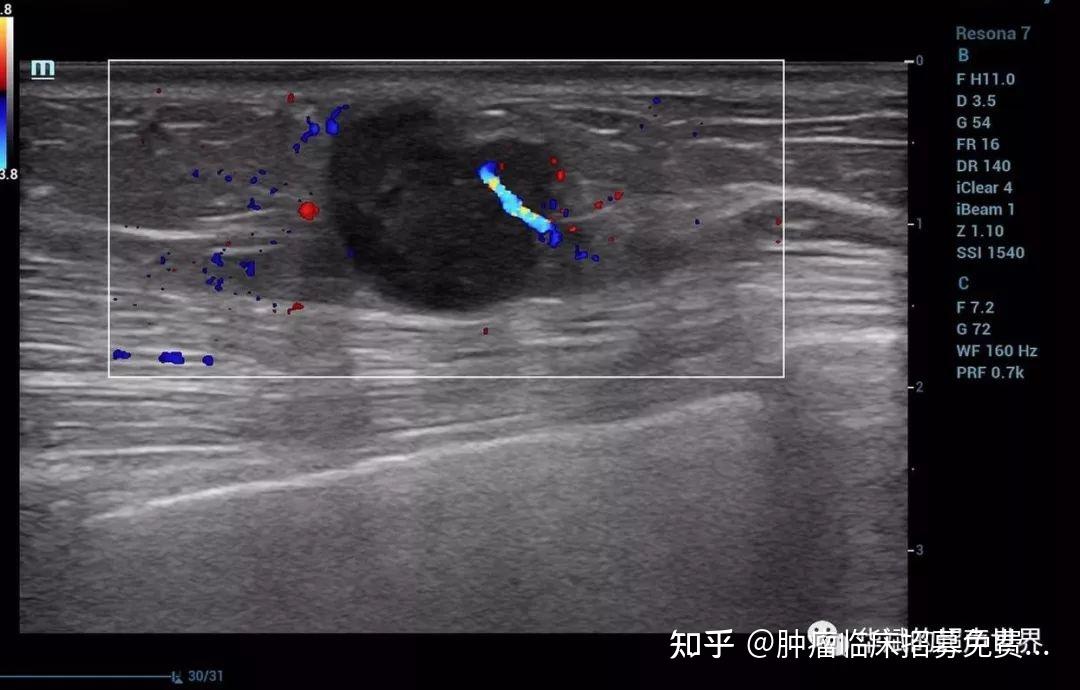 三阴乳腺癌的声像图特点及经典病例分享