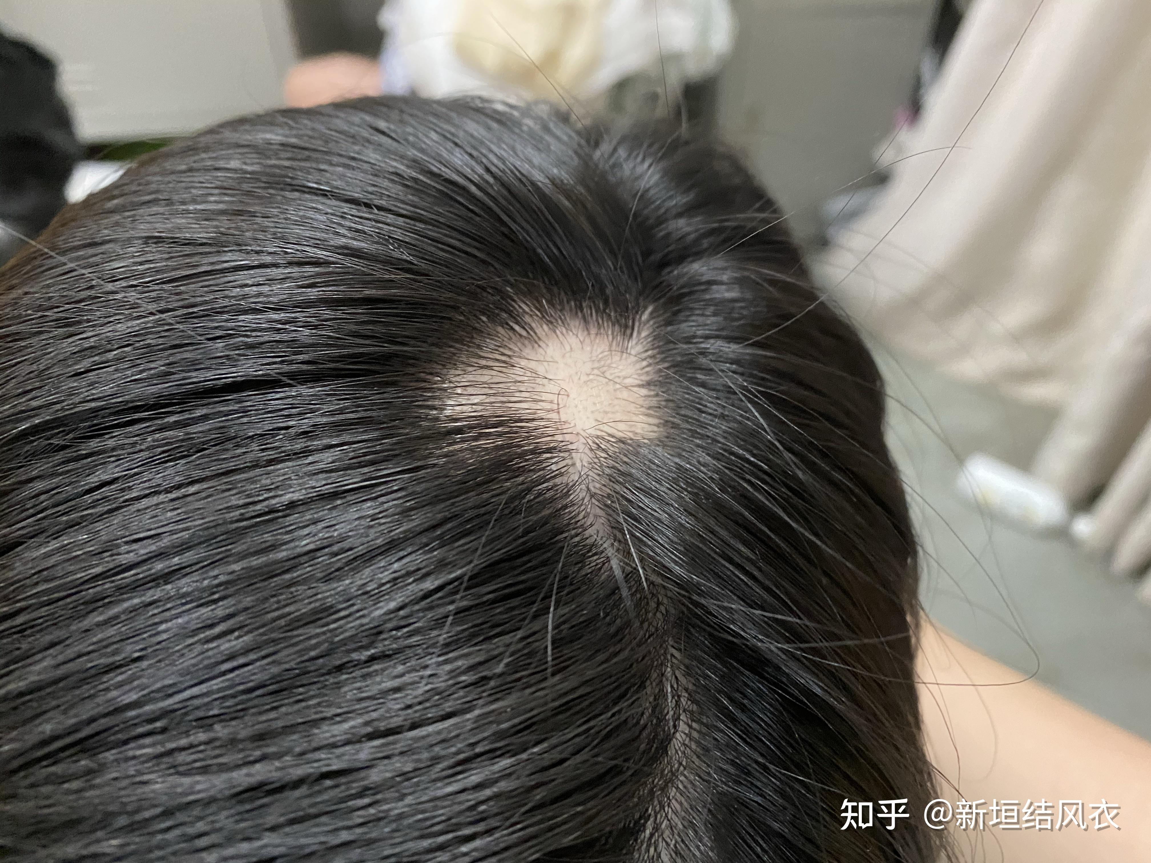 斑秃是一种什么样的体验求解