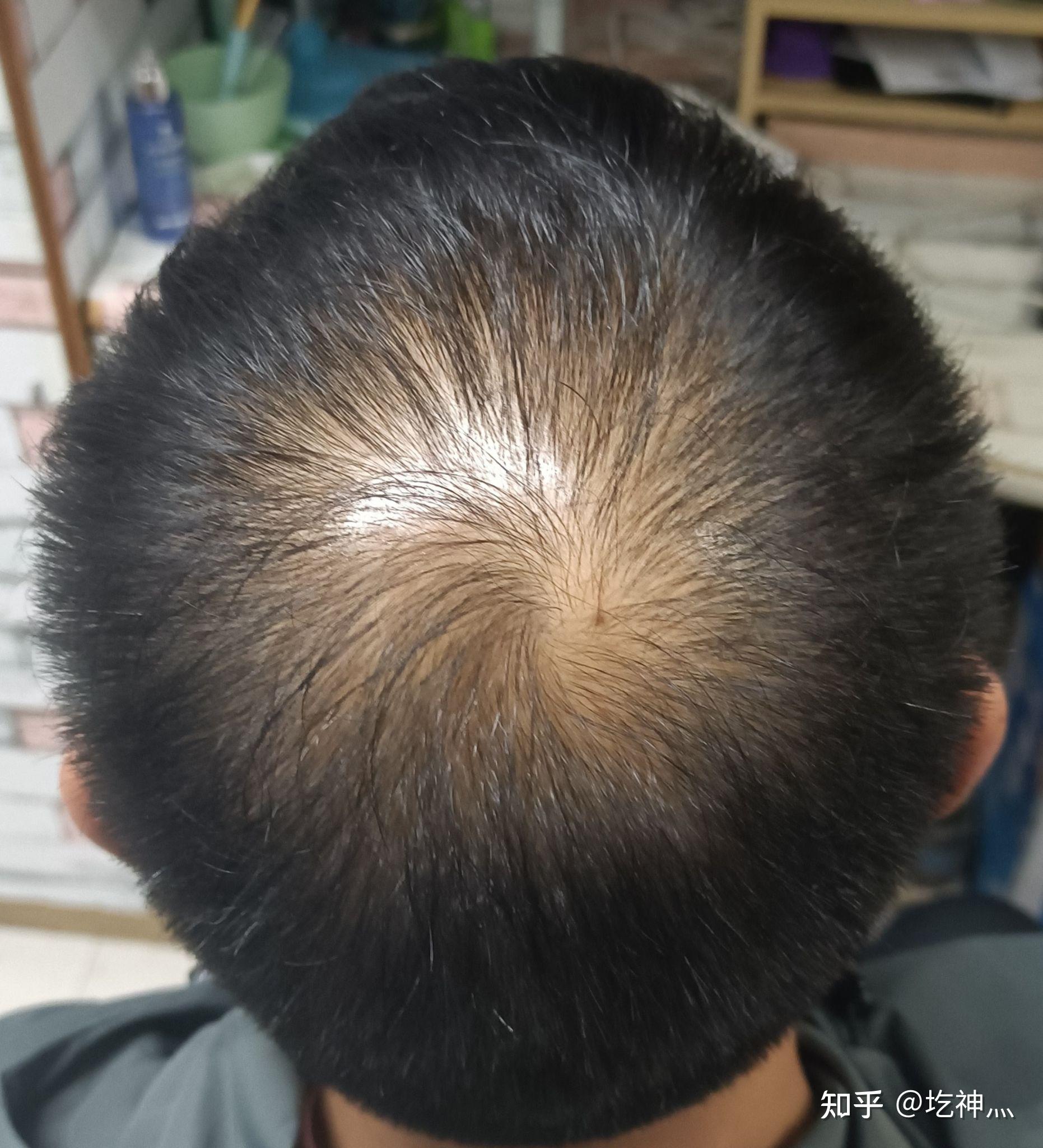 亲测了非那及米诺对雄性脱发的治疗效果