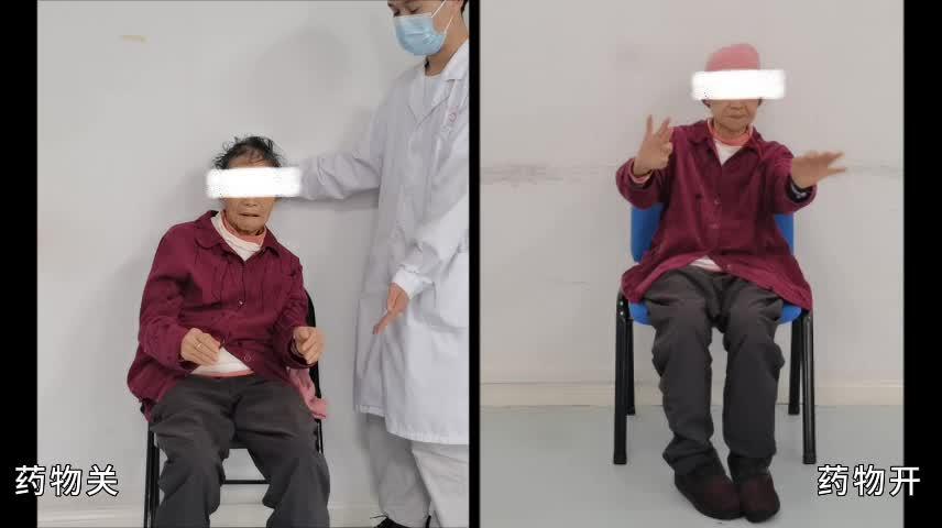 美多芭药物冲击试验症状改善率为35%,从视频中我们也可以看得出,药效