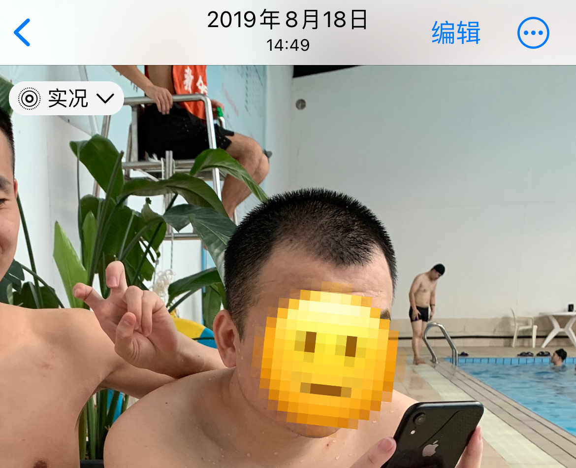 脱发7年、植发4年多，来聊聊脱发&植发，纠结要不要植发的朋友，先看这篇文章！ - 知乎