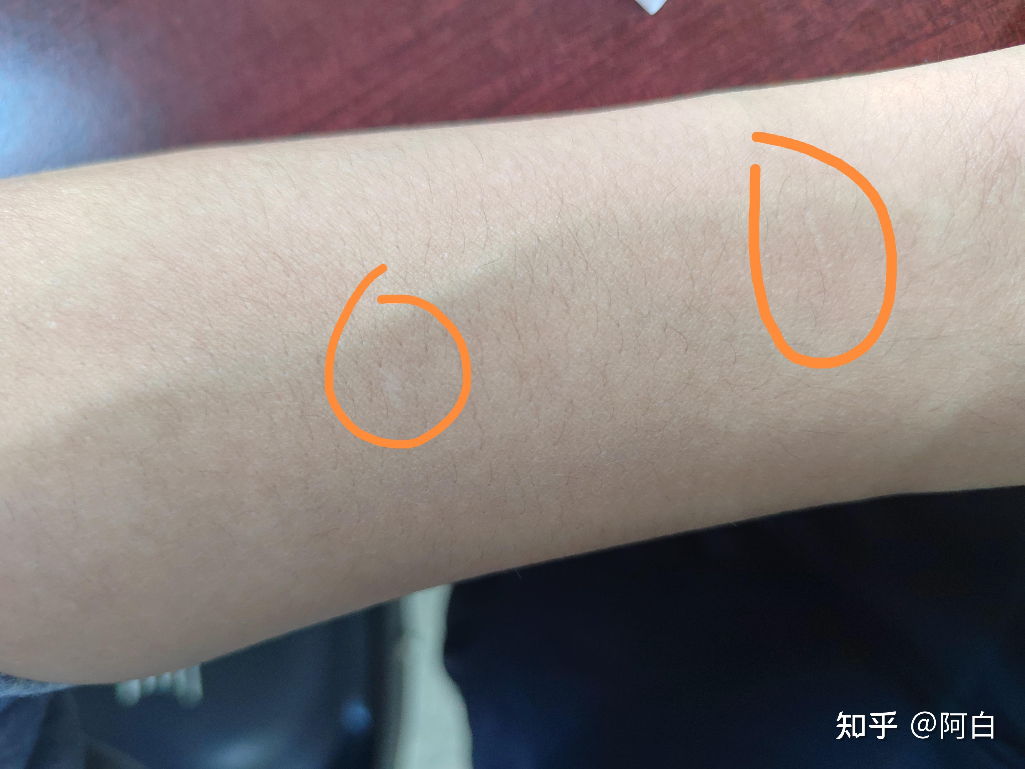 装抑郁的人会自残吗(孩子自残划伤手臂怎么办)