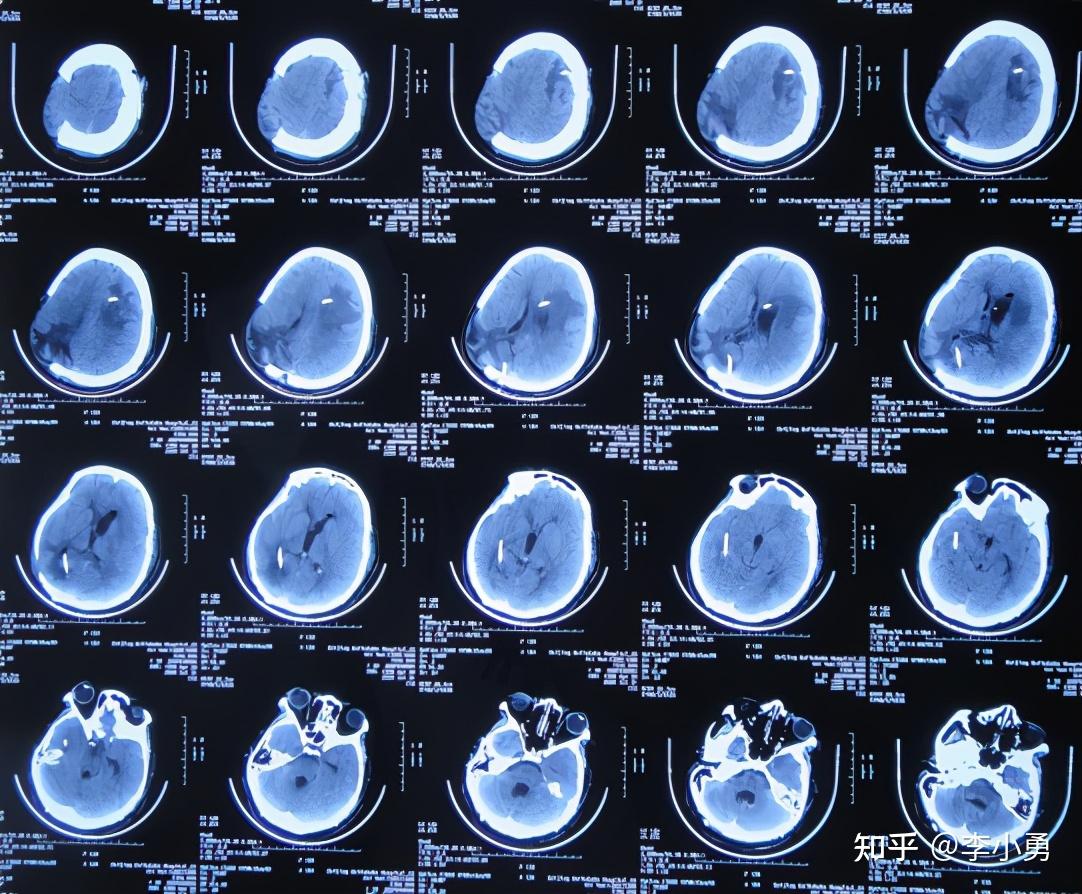 腦血管畸形術後四次腰大池引流腦室外引流和內鏡下側腦室造瘻和三腦室