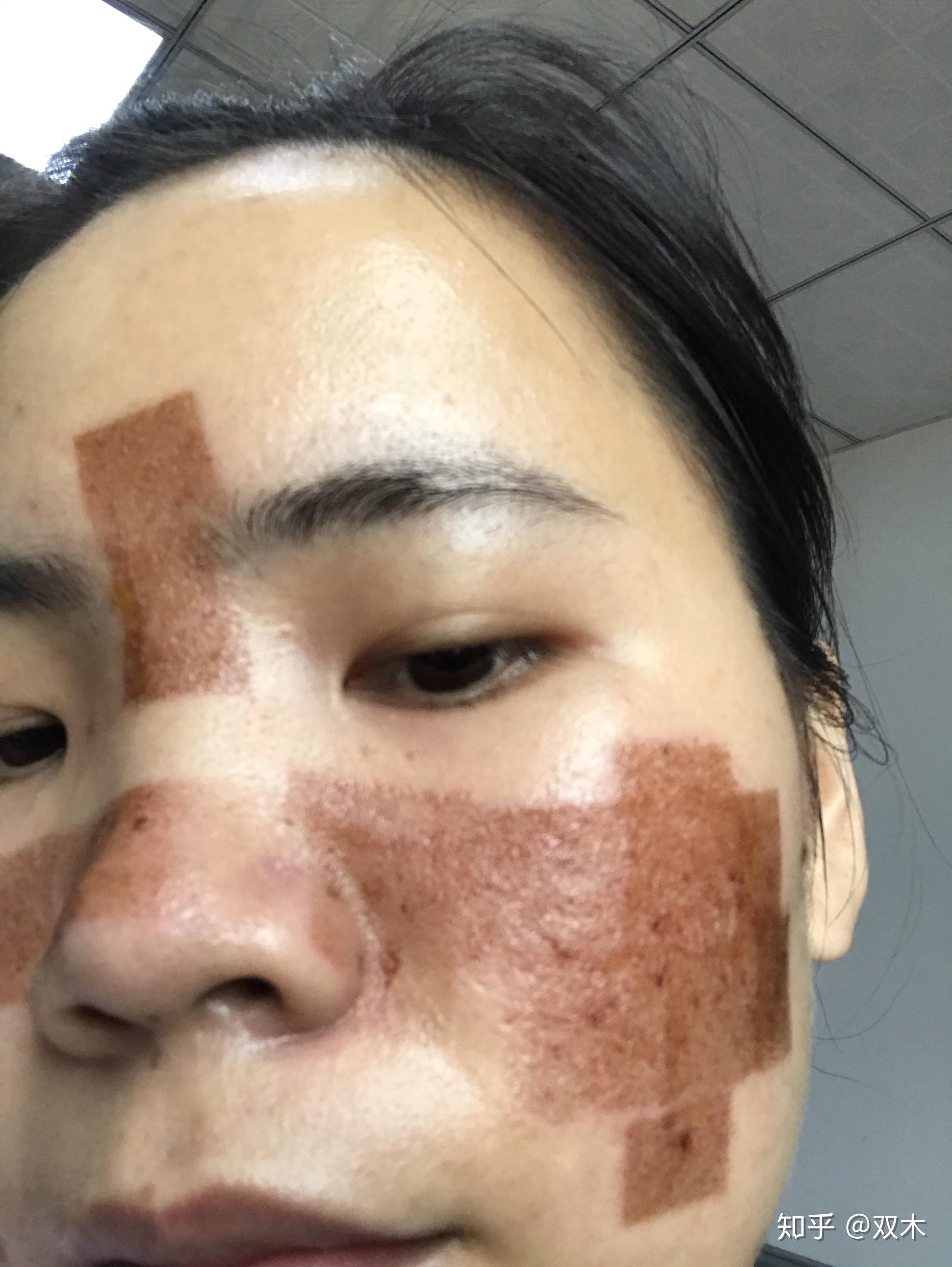 点阵激光第四天