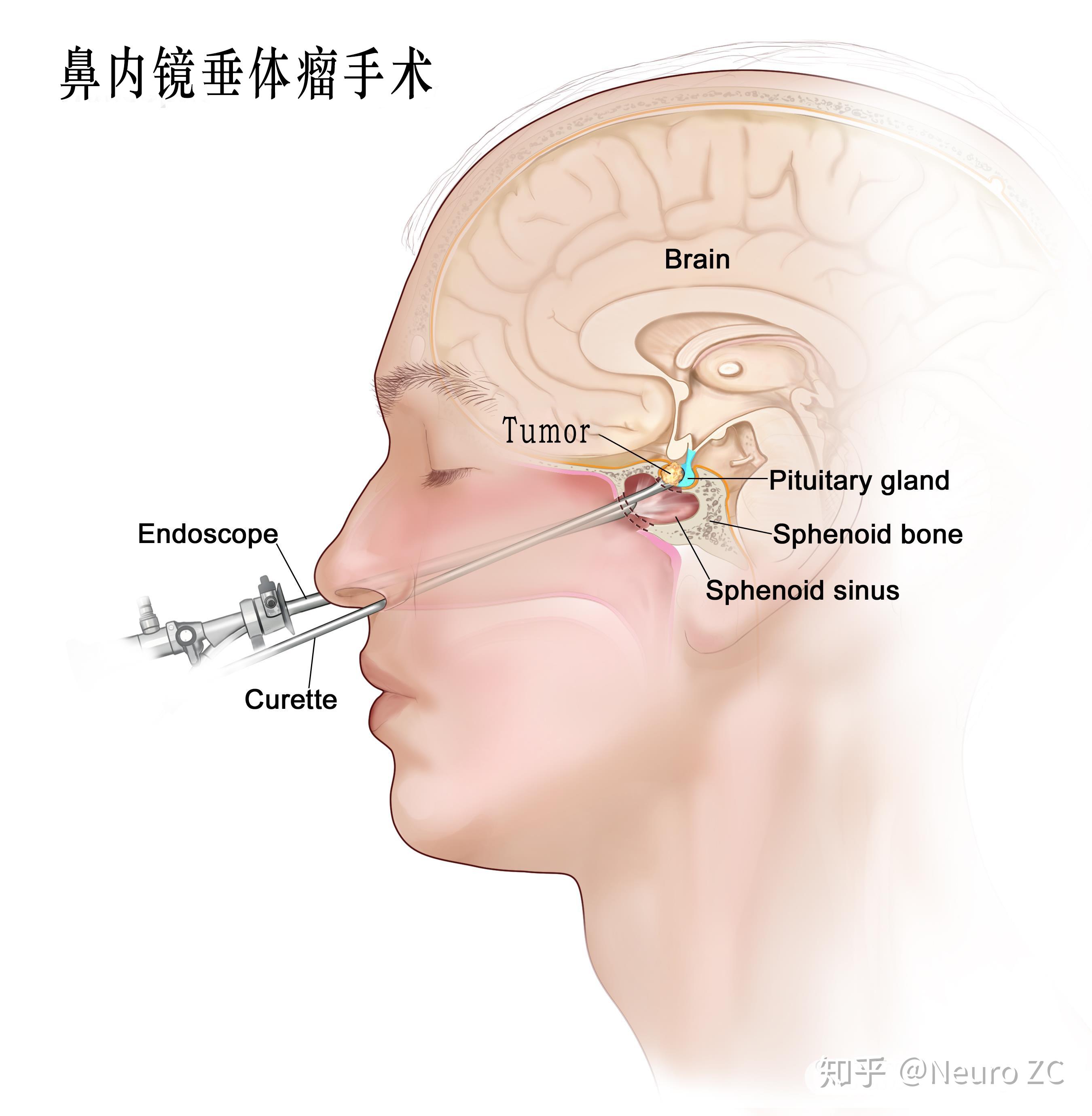 垂体瘤长在哪里图片图片